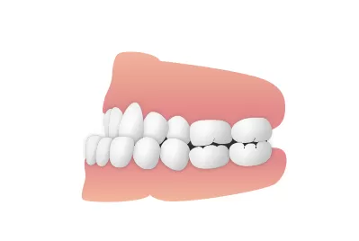 受け口(下顎前突)|東京・足立区の矯正歯科ならさくら参道歯科・矯正歯科