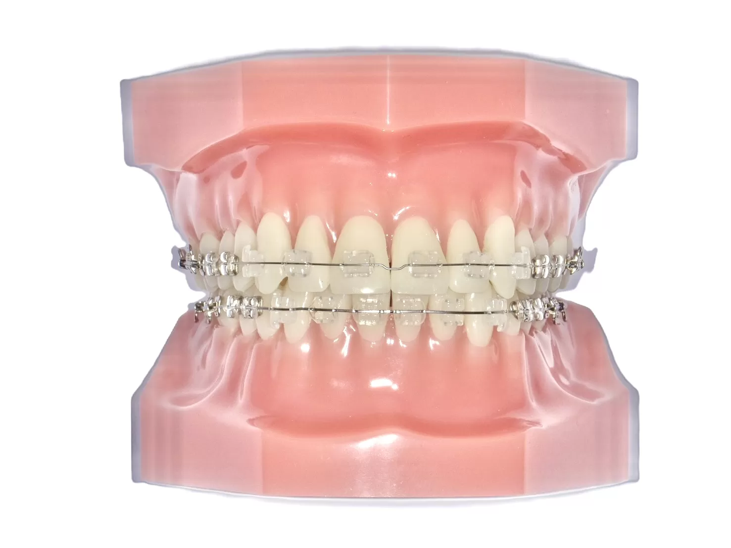 表側矯正|東京・足立区の矯正歯科ならさくら参道歯科・矯正歯科