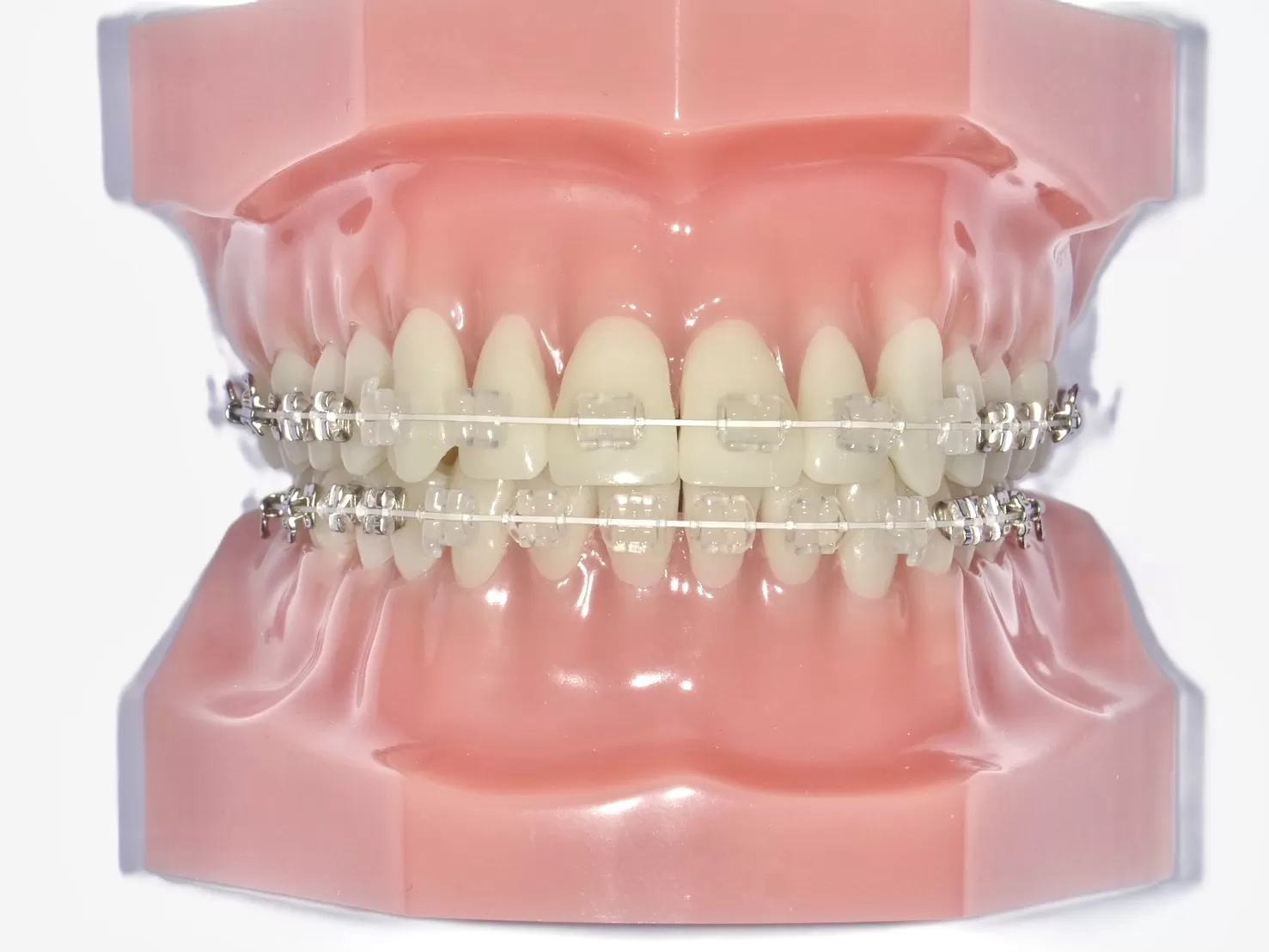 審美的なブラケットにホワイトワイヤー|東京・足立区の矯正歯科ならさくら参道歯科・矯正歯科