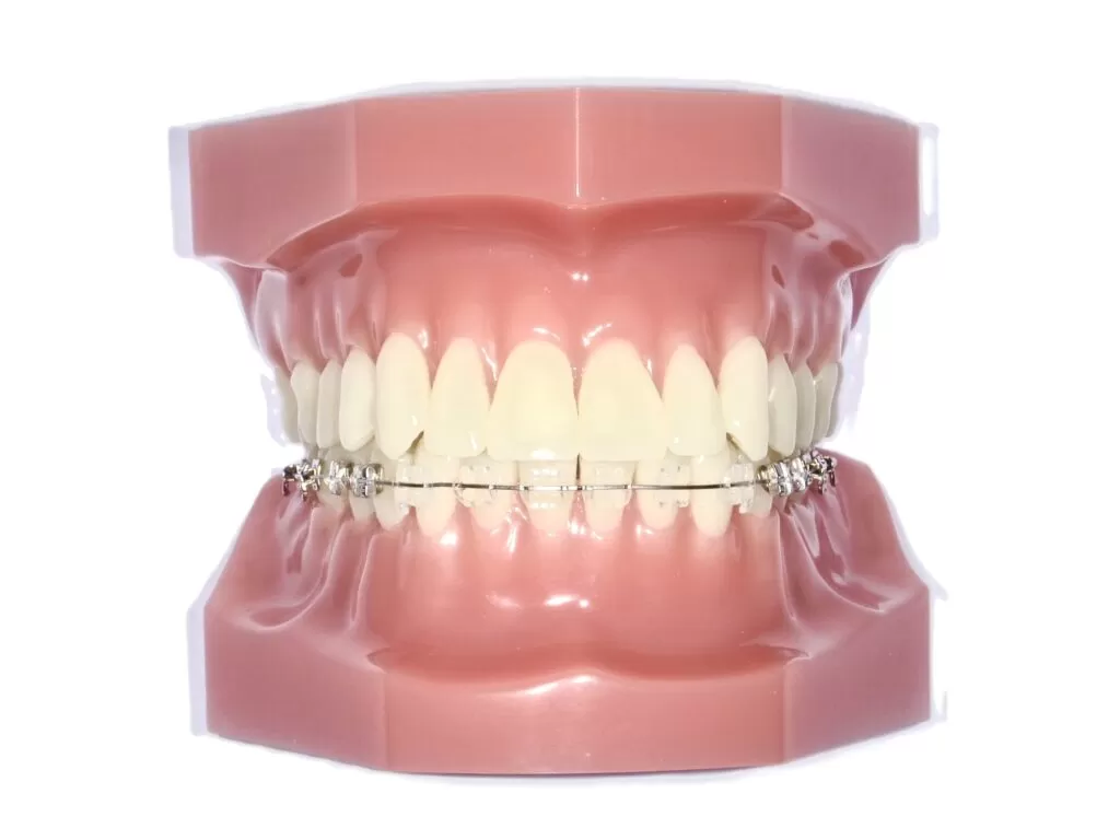 ハーフリンガル(表面)|東京・足立区の矯正歯科ならさくら参道歯科・矯正歯科