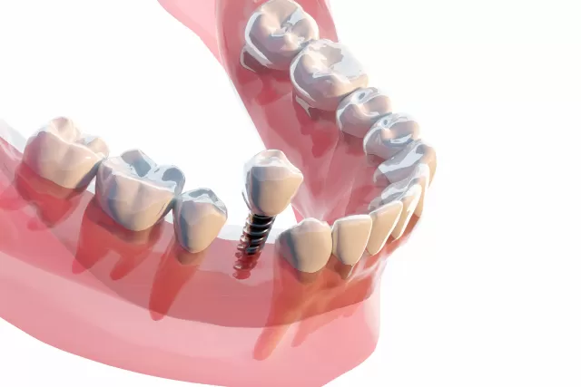 インプラント|足立区西新井の歯医者・矯正歯科|さくら参道歯科・矯正歯科