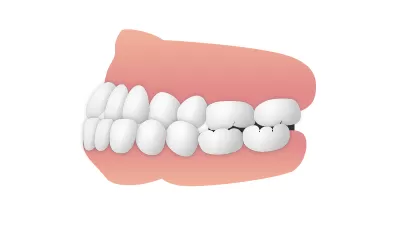 上下顎前突(じょうかがくぜんとつ)|東京・足立区の矯正歯科ならさくら参道歯科・矯正歯科