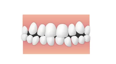 乱杭歯(らんぐいし)/叢生(そうせい)|東京・足立区の矯正歯科ならさくら参道歯科・矯正歯科