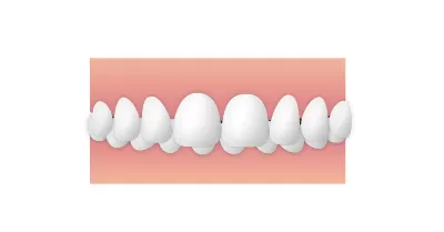 過蓋咬合(かがいこうごう)|東京・足立区の矯正歯科ならさくら参道歯科・矯正歯科