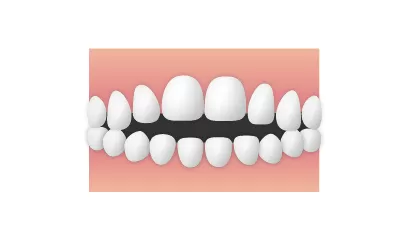 開咬(かいこう)|東京・足立区の矯正歯科ならさくら参道歯科・矯正歯科