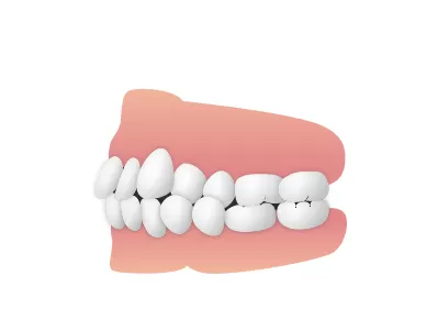 交叉咬合|東京・足立区の矯正歯科ならさくら参道歯科・矯正歯科