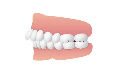出っ歯(上顎前突/じょうがくぜんとつ)|東京・足立区の矯正歯科ならさくら参道歯科・矯正歯科